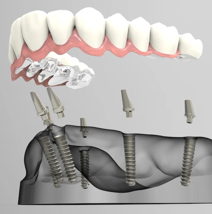 All-On-4 Implants