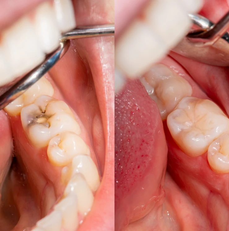 Amalgam (Silver) Fillings