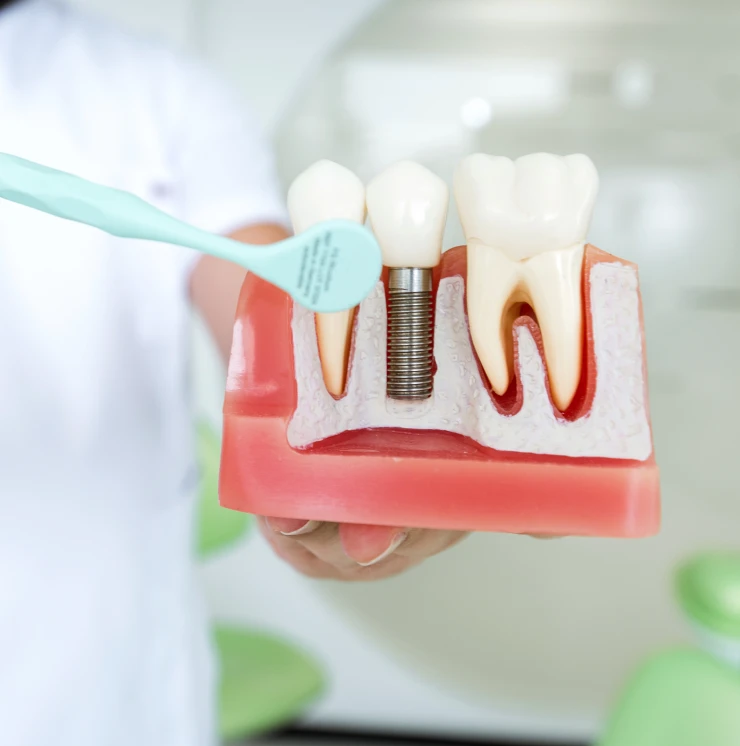 Benefits-of-Dental-Implants