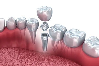 Dental Implants1