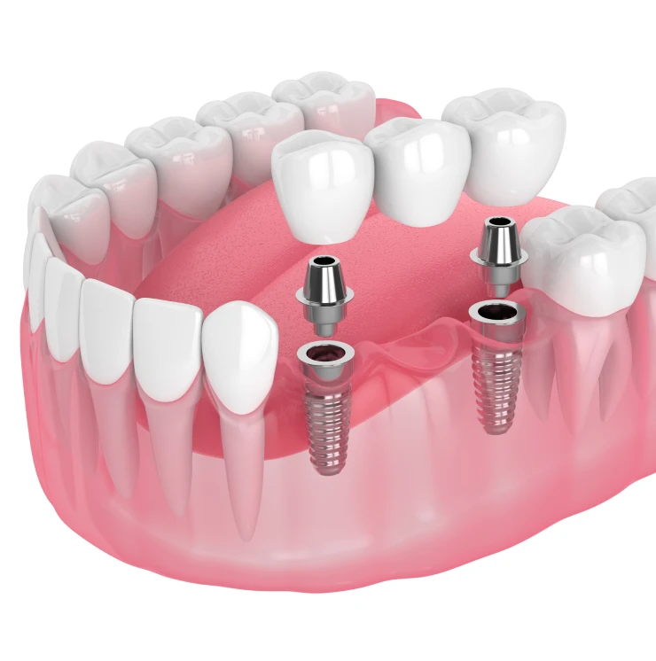 Implant-Supported Bridges