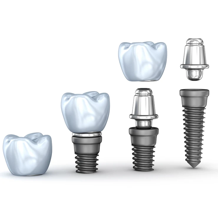 Types of Dental Implants