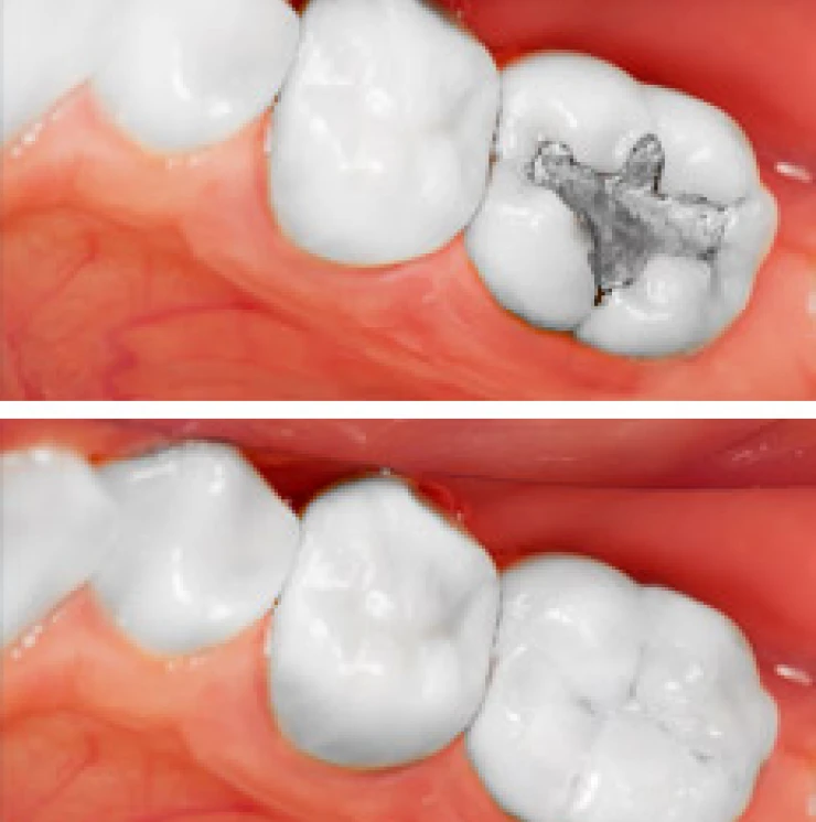 What Are Dental Fillings