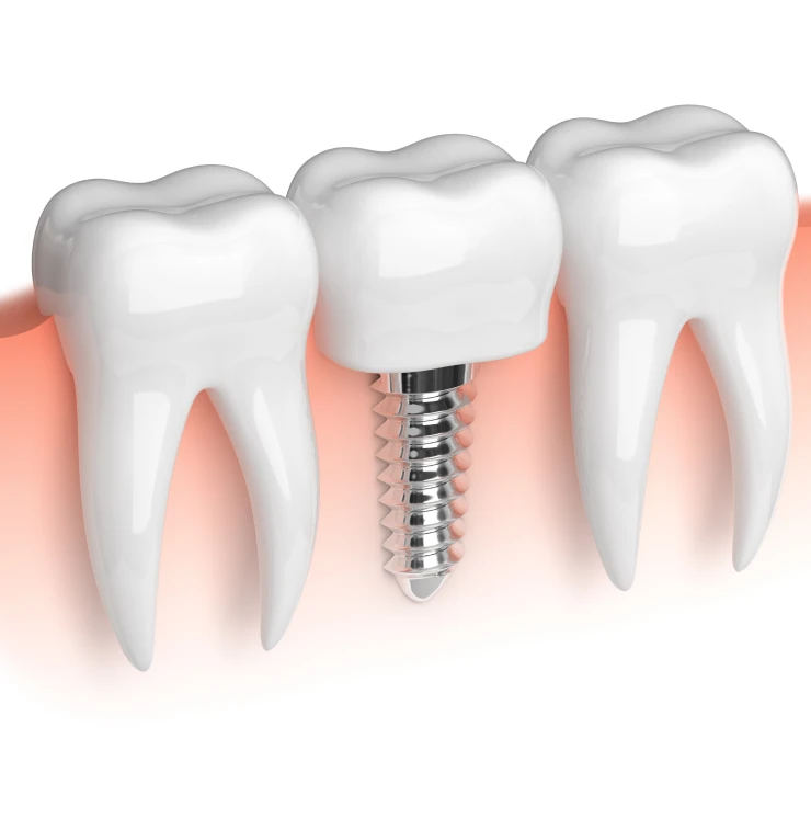 What Are Dental Implants