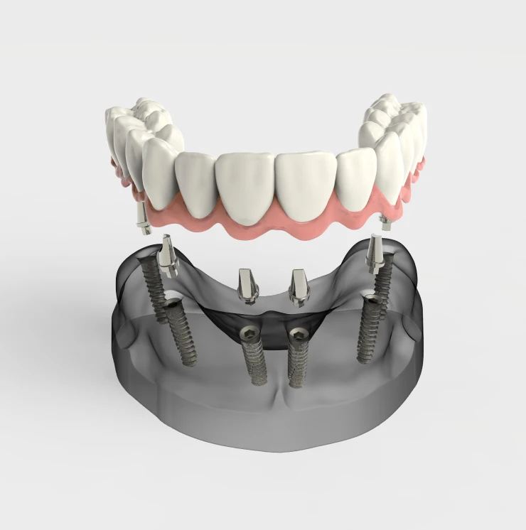 What are the Types of Stabilized Dentures