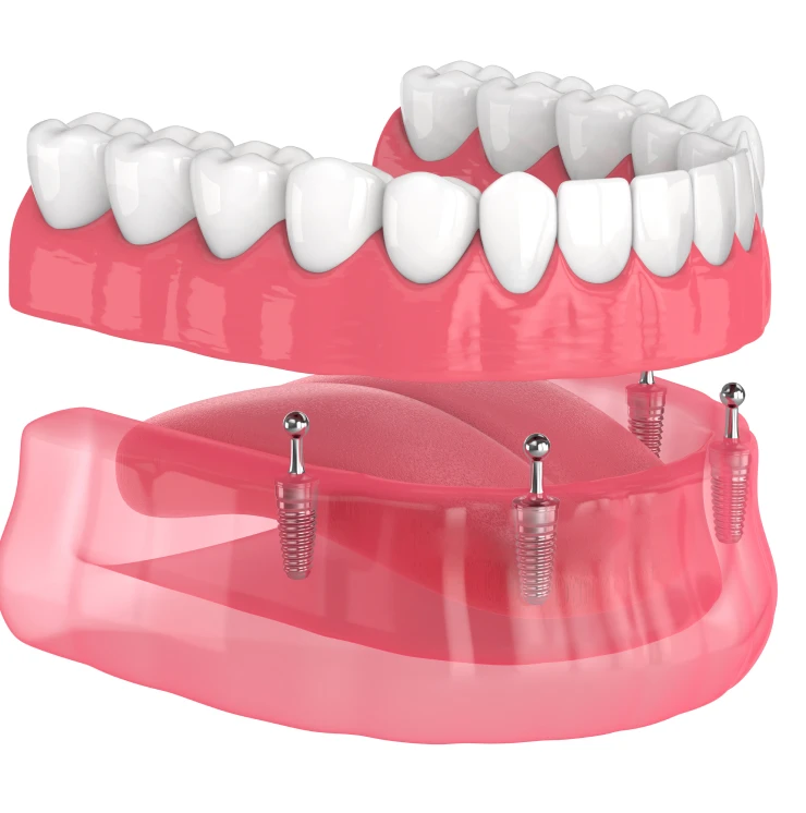 What is Denture Stabilization