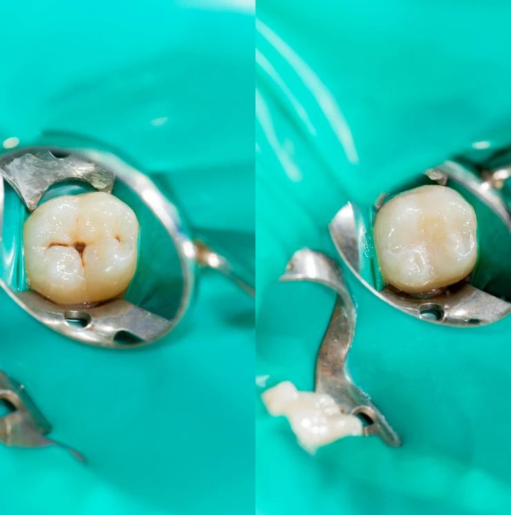 gold Fillings